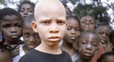 アフリカで「白人」として生まれた子供、この世の地獄から救出される.jpg