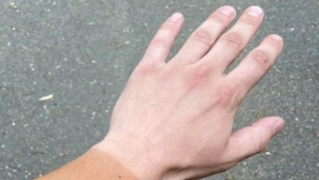 アレルギー反応と日焼けの手.jpg
