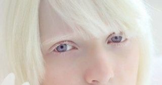 アルビノの人の画像